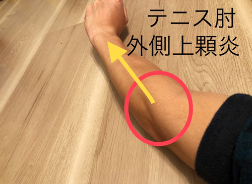 tennis_elbow