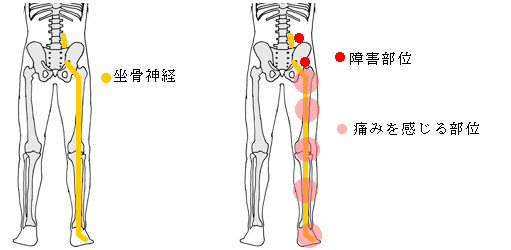 坐骨神経痛の説明画像１ / 広島市中区の整体「かわら町」の整骨